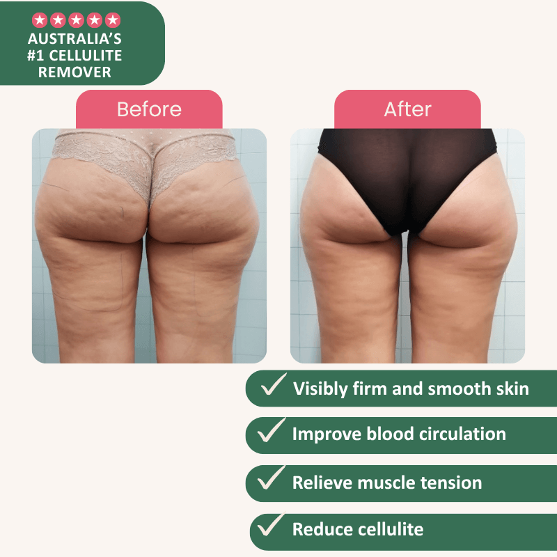 Sculptheory™ Body-Sculpting Cupping Massager image Sculptheory™ Body-Sculpting Cupping Massager